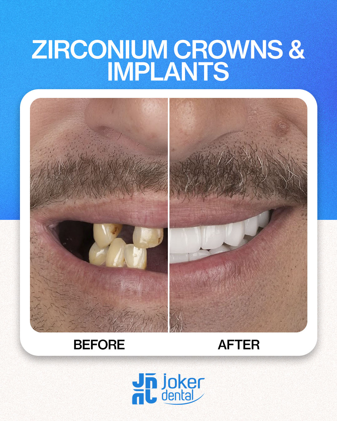 İsdentbul Before After 9