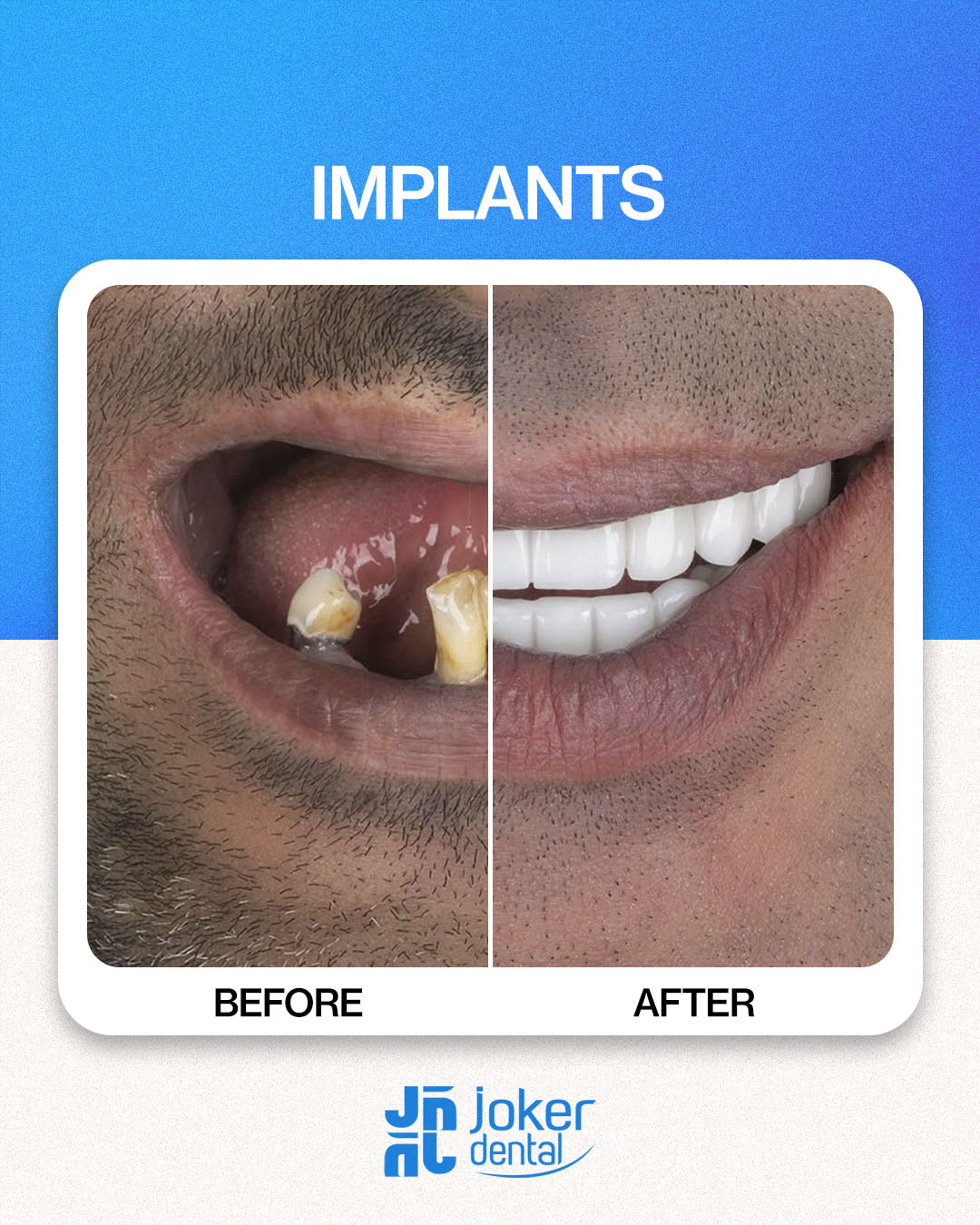 İsdentbul Before After 3