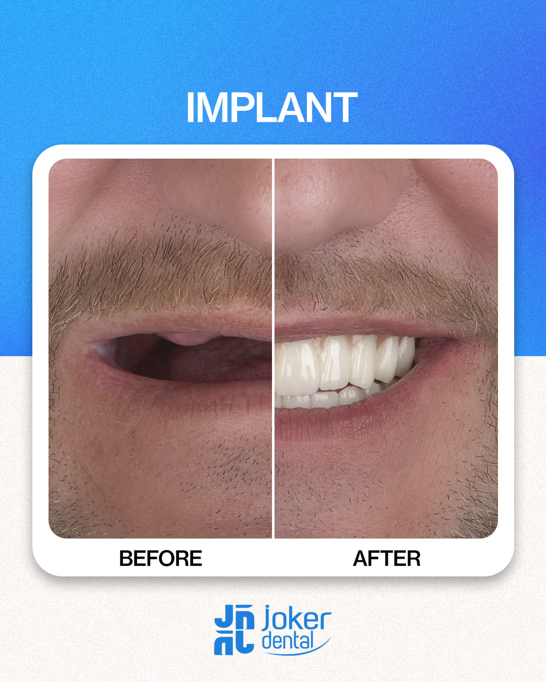 İsdentbul Before After 6